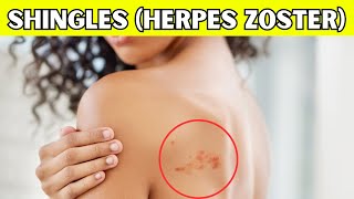 Shingles (Herpes Zoster Infection) - Causes, Signs And Symptoms, Diagnosis, And Treatment