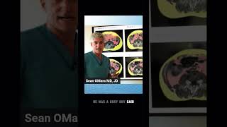 *Part 1* How to get rid of visceral fat, Dr Sean Omara MD JD  #weightloss #diet