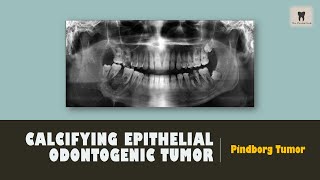 Calcifying Epithelial Odontogenic Tumor | Pindborg Tumor