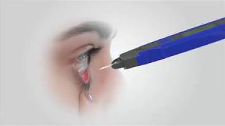 I - PEN Tear Osmolarity System