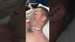 COMO OS LASERS DE REMOVER TATUAGEM FUNCIONAM!?😳🤯