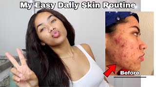 MY EASY DAILY SKIN ROUTINE | ACNE?? | SCARRING?? | HORMONES & BIRTH CONTROL??