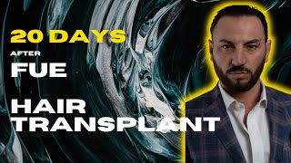 ONLY 20 DAYS | FUE Hair | Transplant | Enny Buono