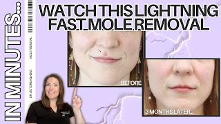 This 60-Second Mole Removal Will Blow Your Mind