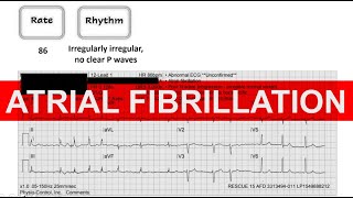 Atrial Fibrillation