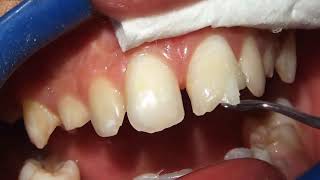 ভাঙা দাঁত ঠিক করার হয় যেভাবে। Tech Dental Care