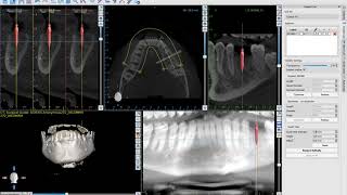 Understanding the "Custom" Kit, the Surgical Kit List and the Add Implants List