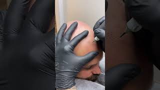 ASMR hair loss tattoo #scalpmicropigmentation #smp #scalptattoo #hairloss