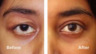 "Blepharochalasis Unveiled: Navigating Upper Eyelid Concerns and Care"