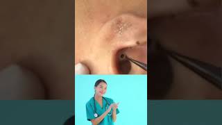 Dr.Nattacha, blackheads ears extraction.