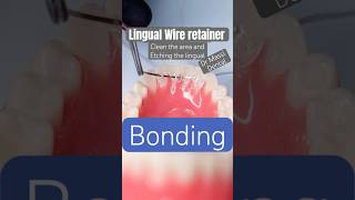 Lingual Wire Retainer , Orthodontics, Braces