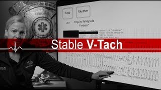 Ventricular Tachycardia: Stable