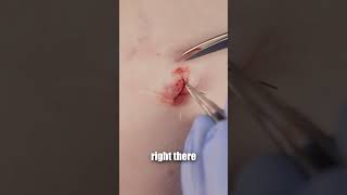 How to take stitches out at home!