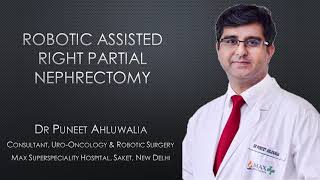 Robotic Assisted Partial Nephrectomy by Dr Puneet Ahluwalia, Max Hospital, Saket