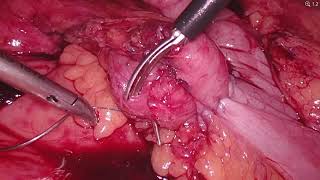 Kron xəstəliyinə görə Laparoskopik REDO əməliyyat / Laparoscopic REDO kolon surgery for Krohn