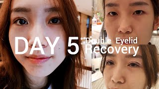 Korean Double Eyelid | Non Incisional Double Eyelid Surgery Recovery