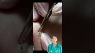 Dr.Natacha, blackhead extraction.