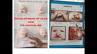 Development of face and its developmental anomalies - Explained with embryology model - made easy