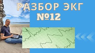 Разбор ЭКГ №12