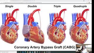 QuickShot: CABG Coding