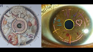 Iridology Lesson #14 pt.1 - Iris Reading with True Brown Eyes, Nerve Rings, Strong Constitution