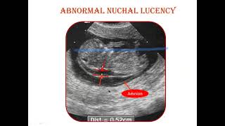 Ultrasound Screening For Fetal Aneuploidies