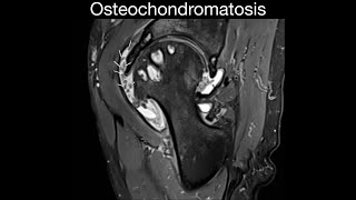 Synovial Osteochondromatosis