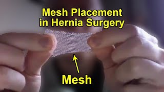 How Surgeons Repair Hernia with Mesh | Laparoscopic Inguinal hernia repair with mesh placement