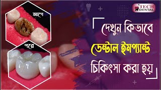 দেখুন কিভাবে ডেন্টাল ইমপ্ল্যান্ট চিকিৎসা করা হয় ।। Dental Implant Treatment Procedure