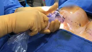 Watch breast implant placement #breastaugmentation