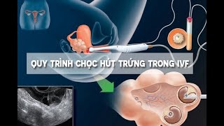 #79 Quá trình chọc hút trứng sẽ diễn ra như thế nào?