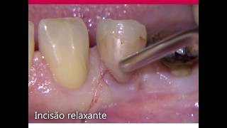 Dente Impactado