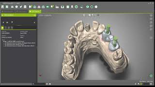 DWOS - Create a bridge on implant