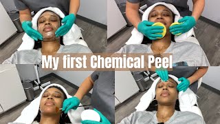 First Chemical Peel Experience | Process & What to expect