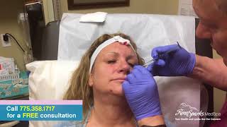 Juvederm Voluma Injections in the Cheek and Cheekbone Area - Reno Sparks MedSpa