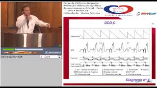 21 Avaliação eletrocardiográfica do marcapasso artificial (parte I). Tipos e modos