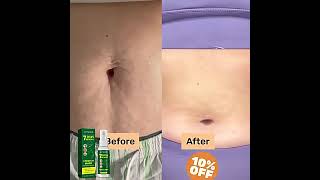 Stretch Marks Removal