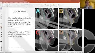 Contouring Pelvis | Session 8: Rectal Cancer