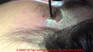 Q Switch Nd Yag Laser Remove Nevus of Ota | Beijing Mejire (3)