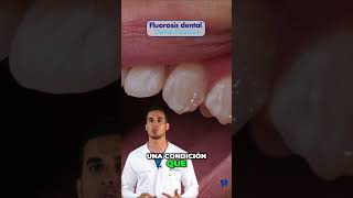 ¿Tienes MANCHAS en los dientes? Podría ser FLUOROSIS dental