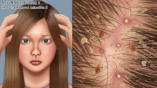 ASMR 보기만 해도 근질근질~ 머릿니 시원하게 제거하기 2ㅣ지루성 두피 치료ㅣGet rid of tons of head lice2