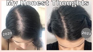 Minoxidil 1 Year Update | does minoxidil work? | Female Hair Loss