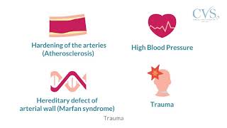 CVSKL: Abdominal Aortic Aneurysm (AAA) Education Video