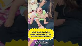 Bayi Viral Yang Menderita Anensefali #anensefali #health #information #edukasi #bayiviral