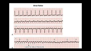 A Flutter dan Ileus Paralytic Patient. What Shoud We Do?