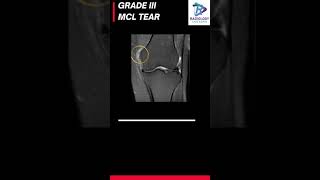 Medial Collateral ligament sprain#MRI KNEE#Sprain