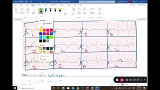 12 Lead Identification