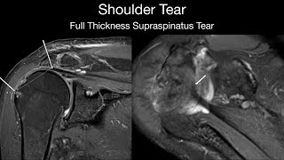 Shoulder Tear