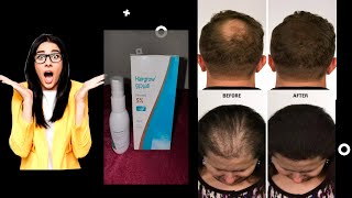 Hairgrow (minoxidil 5%)|| Best minoxidil in dubai|| Best hair growth spray|| Best solutions for hair