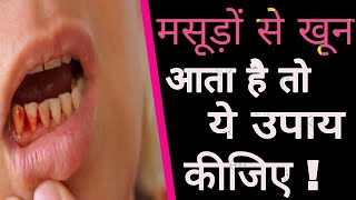 अगर मसूड़ों से खून आए तो यह चार उपाय है कारगर | Home remedies for gums bleeding in Hindi |